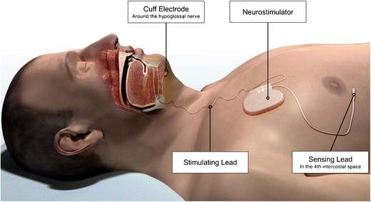 Upper airway stimulation