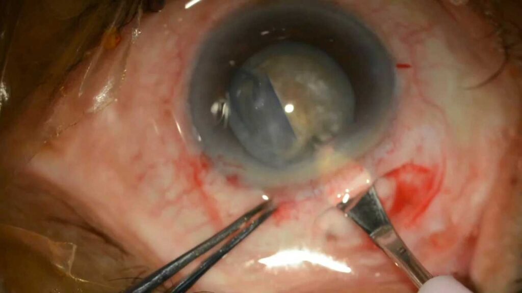 Small Incision Cataract Surgery