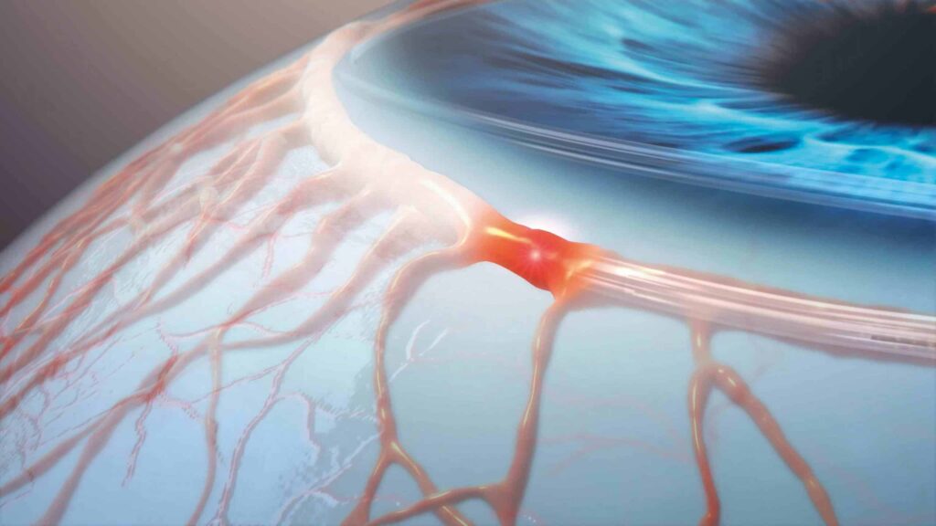 canal-based-glaucoma